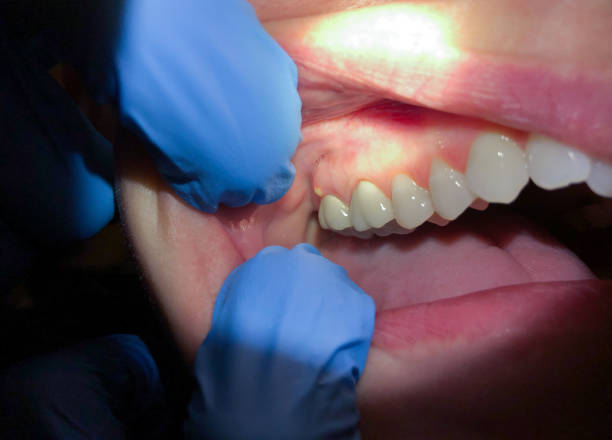 Best Emergency Care for Gum Disease in Dixon, MO